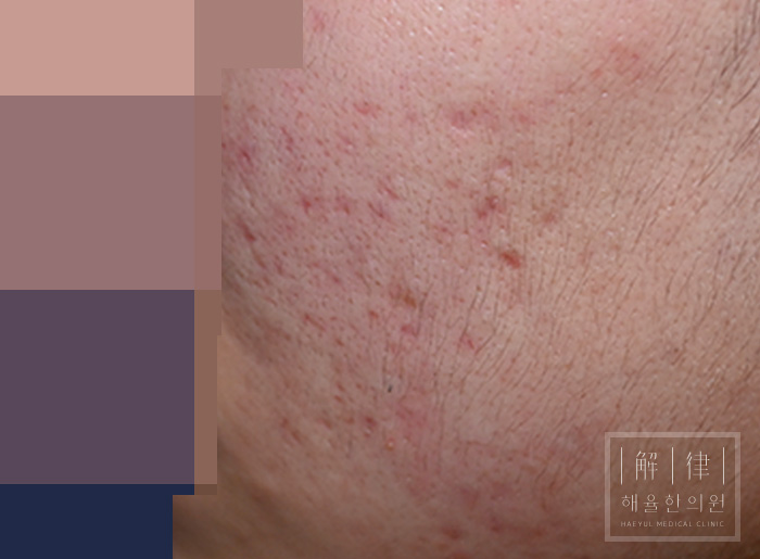 [목동점] 여드름흉터 치료 전 사진 - 해율한의원